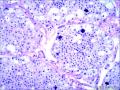 肾：嫌色性肾细胞癌图4