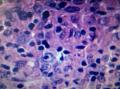结节性淋巴细胞为主霍奇金淋巴瘤图11