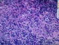 结节性淋巴细胞为主霍奇金淋巴瘤图7