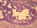 乳腺肿物，是报“乳腺导管异型增生癌变”还是“导管原位癌（中级别）”？图11