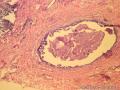 乳腺肿物，是报“乳腺导管异型增生癌变”还是“导管原位癌（中级别）”？图7