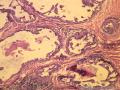 乳腺肿物，是报“乳腺导管异型增生癌变”还是“导管原位癌（中级别）”？图6