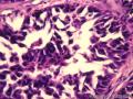 乳腺肿物，是报“乳腺导管异型增生癌变”还是“导管原位癌（中级别）”？图2