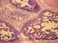 乳腺肿物，是报“乳腺导管异型增生癌变”还是“导管原位癌（中级别）”？图24