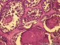 乳腺肿物，是报“乳腺导管异型增生癌变”还是“导管原位癌（中级别）”？图1