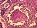 乳腺肿物，是报“乳腺导管异型增生癌变”还是“导管原位癌（中级别）”？图3