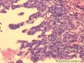 乳腺肿物，是报“乳腺导管异型增生癌变”还是“导管原位癌（中级别）”？图17