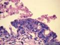 乳腺肿物，是报“乳腺导管异型增生癌变”还是“导管原位癌（中级别）”？图18