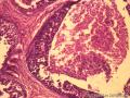 乳腺肿物，是报“乳腺导管异型增生癌变”还是“导管原位癌（中级别）”？图4