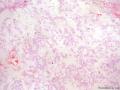 经典病例学习-肺浸润性粘液腺癌（原肺泡细胞癌）图3
