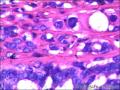 右侧乳腺外周性（微）乳头状瘤伴DCIS及间质巨细胞图34