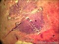 右侧乳腺外周性（微）乳头状瘤伴DCIS及间质巨细胞图3