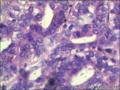 右侧乳腺外周性（微）乳头状瘤伴DCIS及间质巨细胞图27