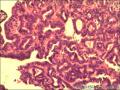 右侧乳腺外周性（微）乳头状瘤伴DCIS及间质巨细胞图9