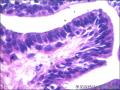右侧乳腺外周性（微）乳头状瘤伴DCIS及间质巨细胞图19