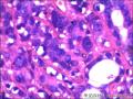 右侧乳腺外周性（微）乳头状瘤伴DCIS及间质巨细胞图29