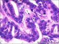 右侧乳腺外周性（微）乳头状瘤伴DCIS及间质巨细胞图14