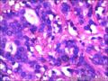 右侧乳腺外周性（微）乳头状瘤伴DCIS及间质巨细胞图30