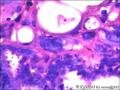右侧乳腺外周性（微）乳头状瘤伴DCIS及间质巨细胞图38