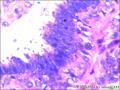 右侧乳腺外周性（微）乳头状瘤伴DCIS及间质巨细胞图24
