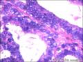 右侧乳腺外周性（微）乳头状瘤伴DCIS及间质巨细胞图17