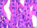 右侧乳腺外周性（微）乳头状瘤伴DCIS及间质巨细胞图13