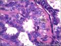 右侧乳腺外周性（微）乳头状瘤伴DCIS及间质巨细胞图15
