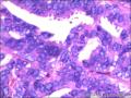 右侧乳腺外周性（微）乳头状瘤伴DCIS及间质巨细胞图16