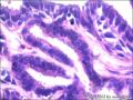 右侧乳腺外周性（微）乳头状瘤伴DCIS及间质巨细胞图20