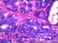 右侧乳腺外周性（微）乳头状瘤伴DCIS及间质巨细胞图36