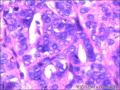 右侧乳腺外周性（微）乳头状瘤伴DCIS及间质巨细胞图25