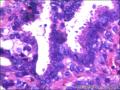 右侧乳腺外周性（微）乳头状瘤伴DCIS及间质巨细胞图18