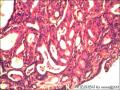 右侧乳腺外周性（微）乳头状瘤伴DCIS及间质巨细胞图7