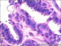 右侧乳腺外周性（微）乳头状瘤伴DCIS及间质巨细胞图22