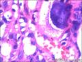 右侧乳腺外周性（微）乳头状瘤伴DCIS及间质巨细胞图31