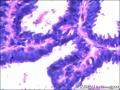 右侧乳腺外周性（微）乳头状瘤伴DCIS及间质巨细胞图23