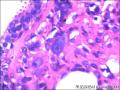 右侧乳腺外周性（微）乳头状瘤伴DCIS及间质巨细胞图35