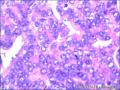 右侧乳腺外周性（微）乳头状瘤伴DCIS及间质巨细胞图40