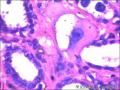 右侧乳腺外周性（微）乳头状瘤伴DCIS及间质巨细胞图39