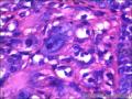 右侧乳腺外周性（微）乳头状瘤伴DCIS及间质巨细胞图43