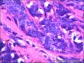 右侧乳腺外周性（微）乳头状瘤伴DCIS及间质巨细胞图37