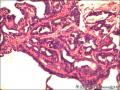 右侧乳腺外周性（微）乳头状瘤伴DCIS及间质巨细胞图12