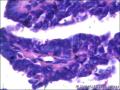 右侧乳腺外周性（微）乳头状瘤伴DCIS及间质巨细胞图26