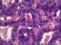 右侧乳腺外周性（微）乳头状瘤伴DCIS及间质巨细胞图28