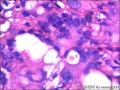 右侧乳腺外周性（微）乳头状瘤伴DCIS及间质巨细胞图32
