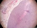 右侧睾丸包块1月余，新增免疫组化。图2