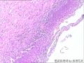 宫颈锥切 鳞化还是CIN1，怎么鉴别？图3