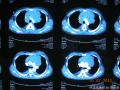 纵膈肿物胸腔镜活检标本，少见形态，诊断？图4