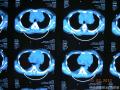 纵膈肿物胸腔镜活检标本，少见形态，诊断？图3