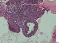 看看这个是子宫内膜异位症吧？周围怎么会形成囊腔的？图4